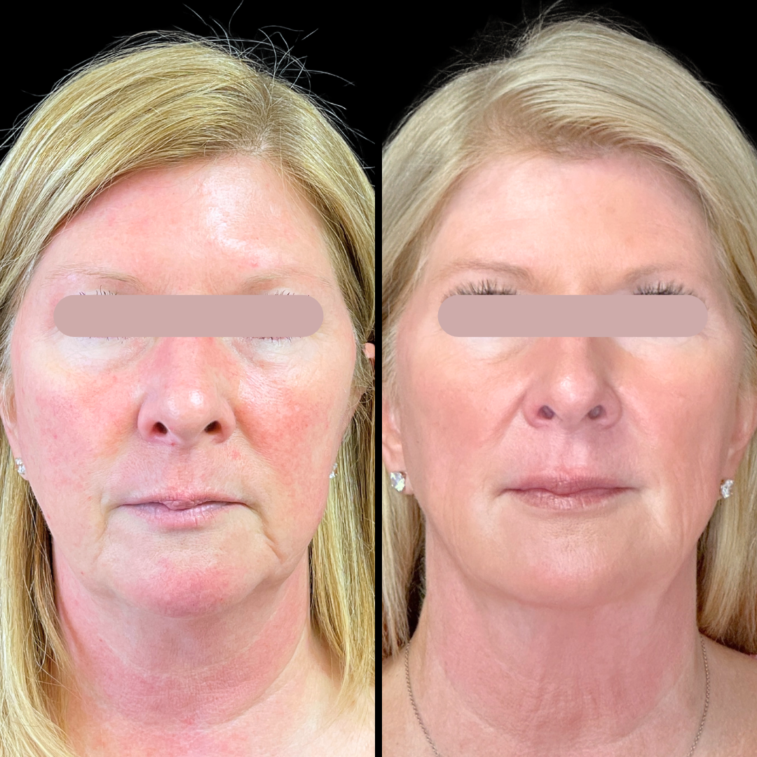 Skincare B&A (3).png