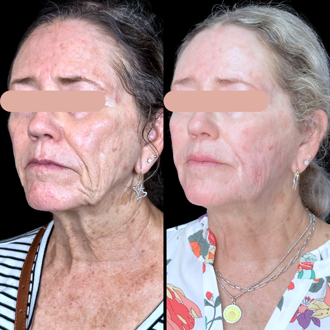 Filler B&A (6).png