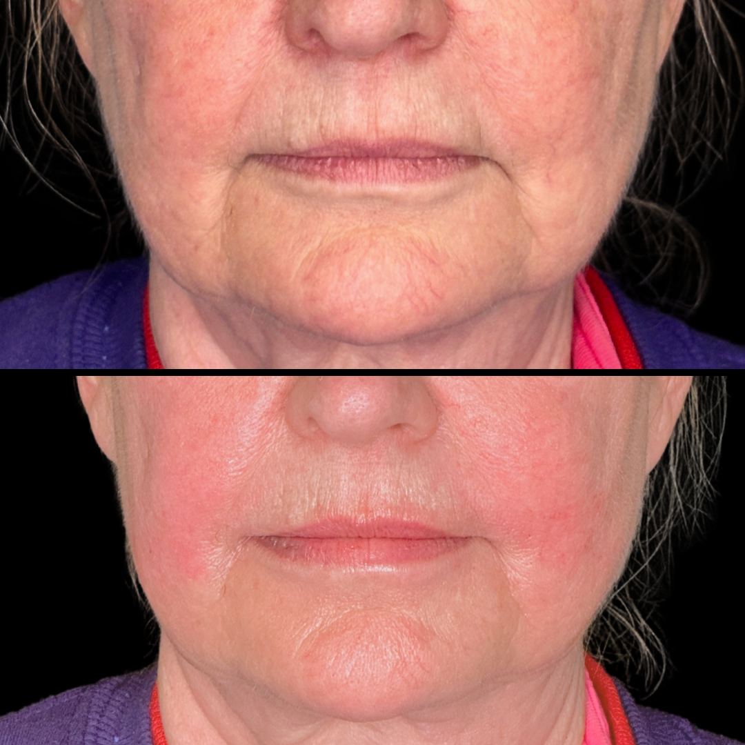 Filler B&A (7).png