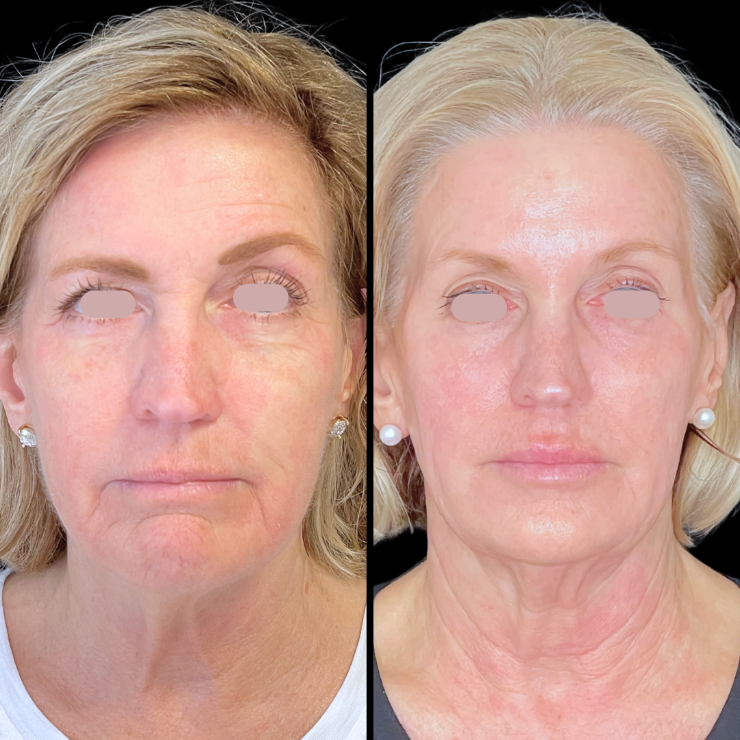 Skincare B&A.png