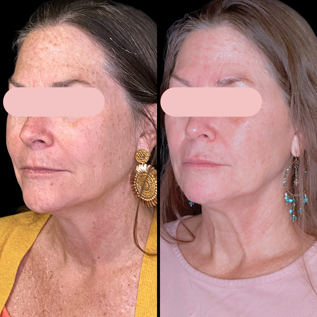 RFMN B&A (1).png
