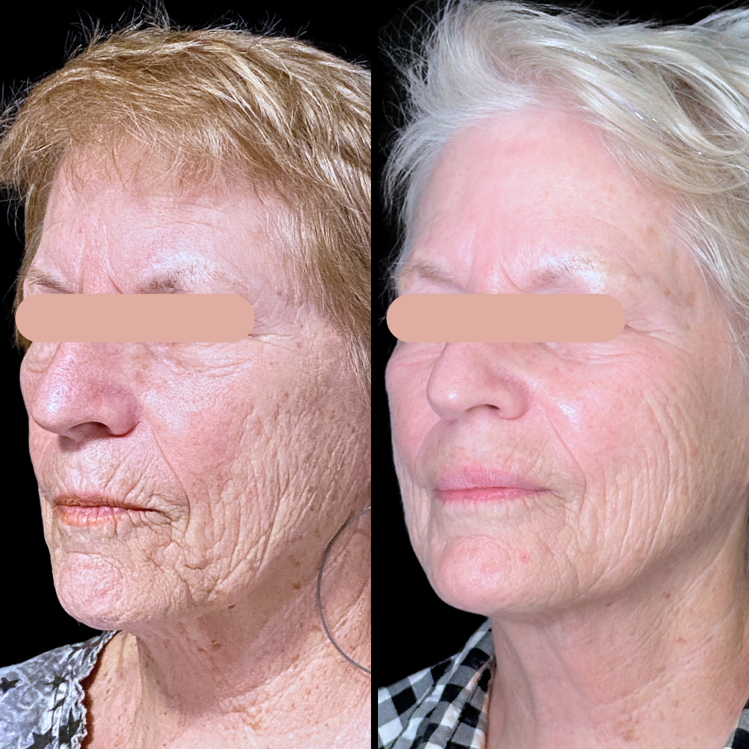 Filler B&A (3).png