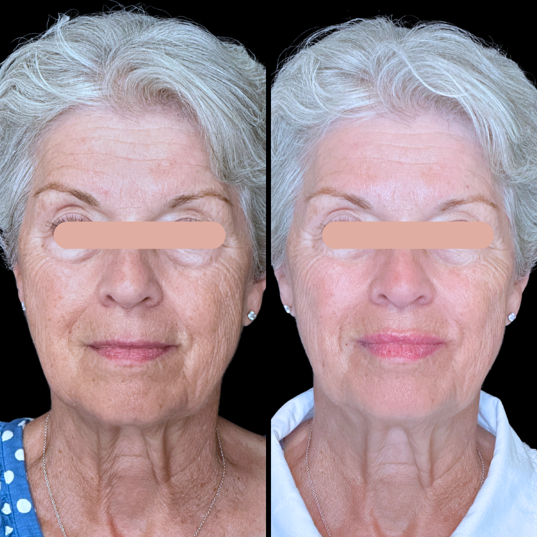 Filler B&A (1).png