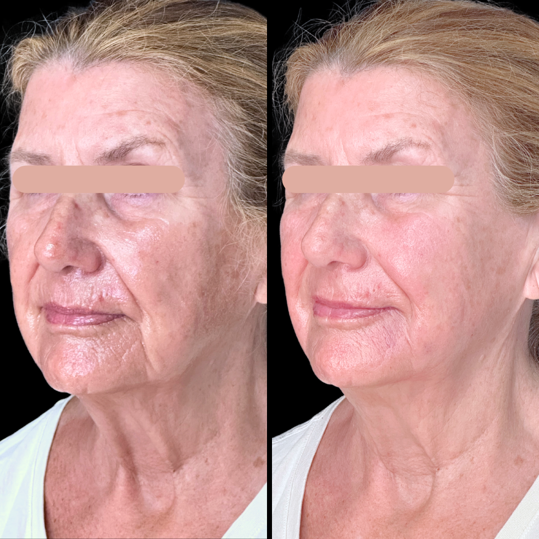 Filler B&A.png