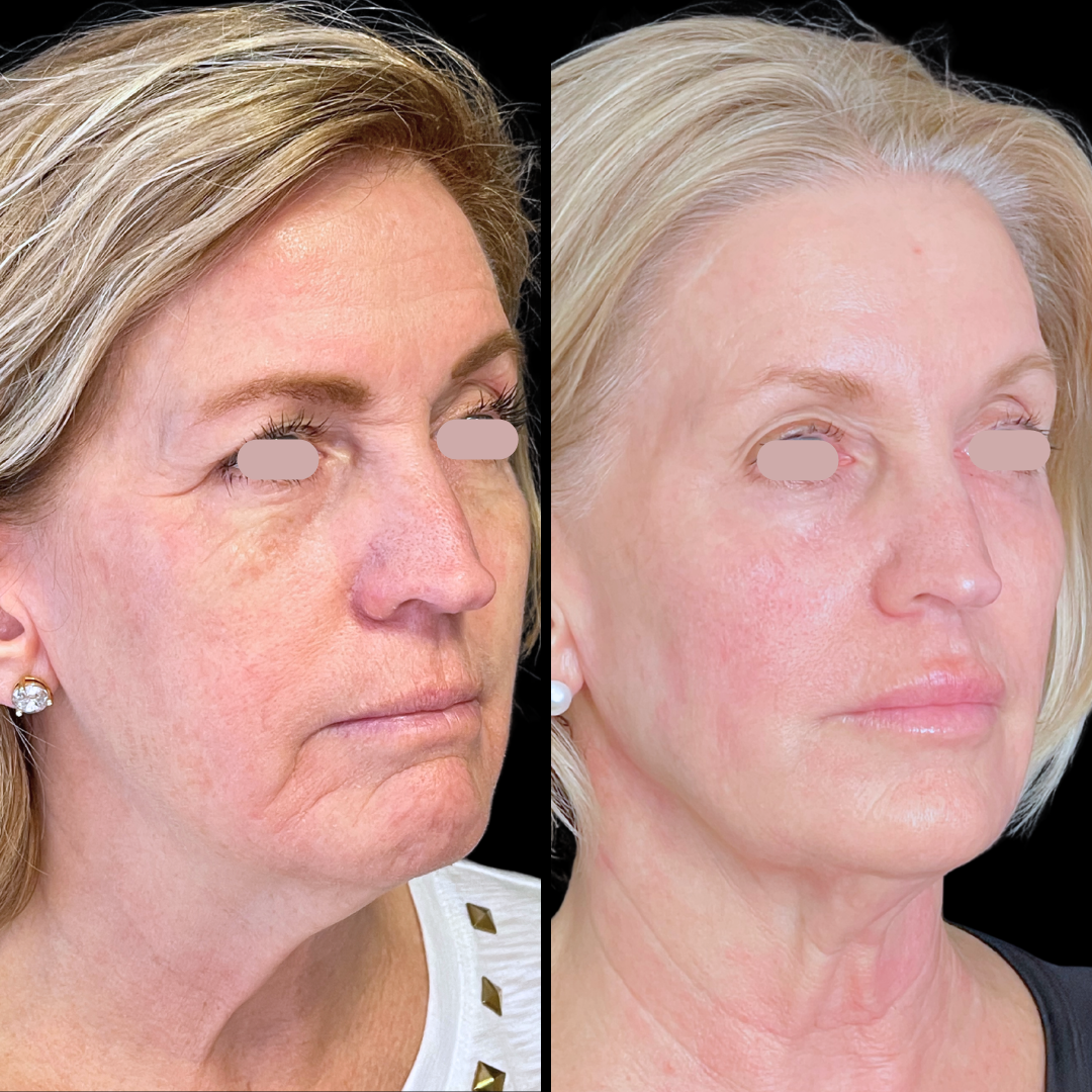 Skincare B&A (1).png