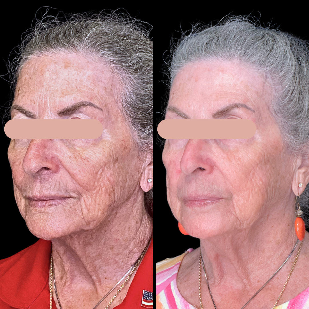 Filler B&A (4).png