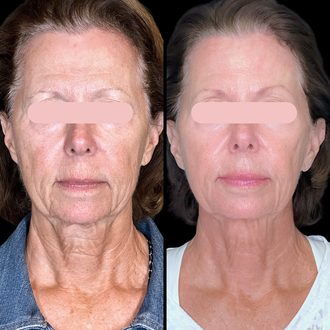 RFMN B&A.png