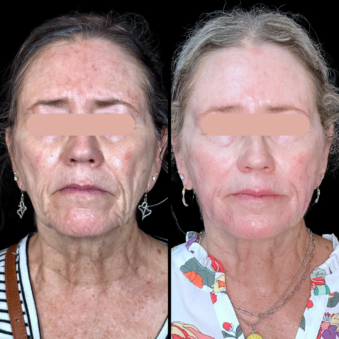 Filler B&A (5).png