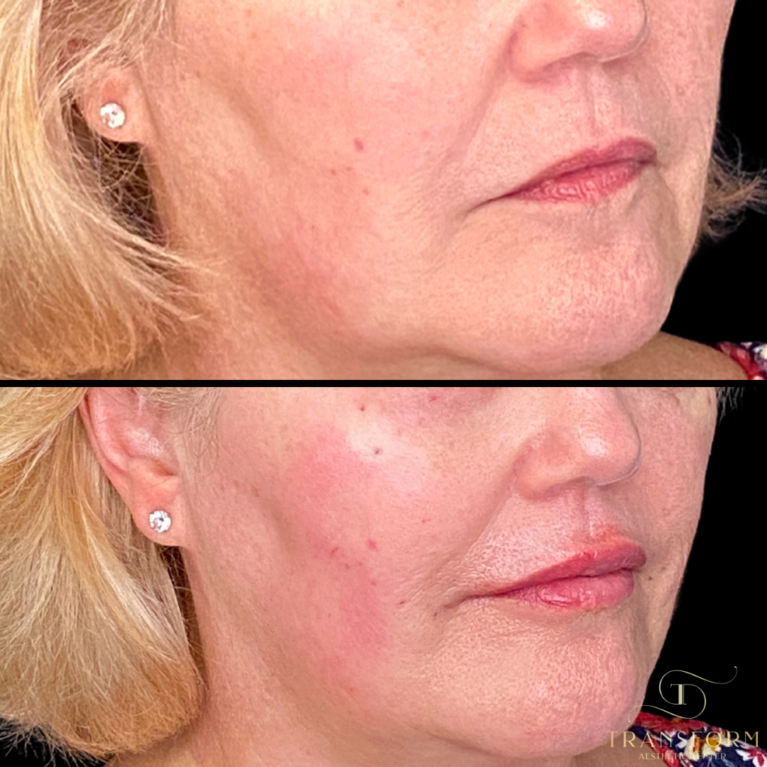 Filler B&A (8).png