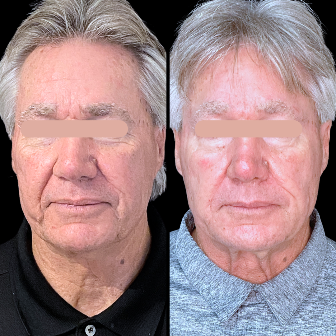 Filler B&A (2).png