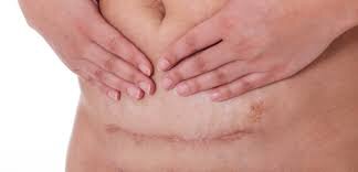 Is it normal for my c-section scar to itch?