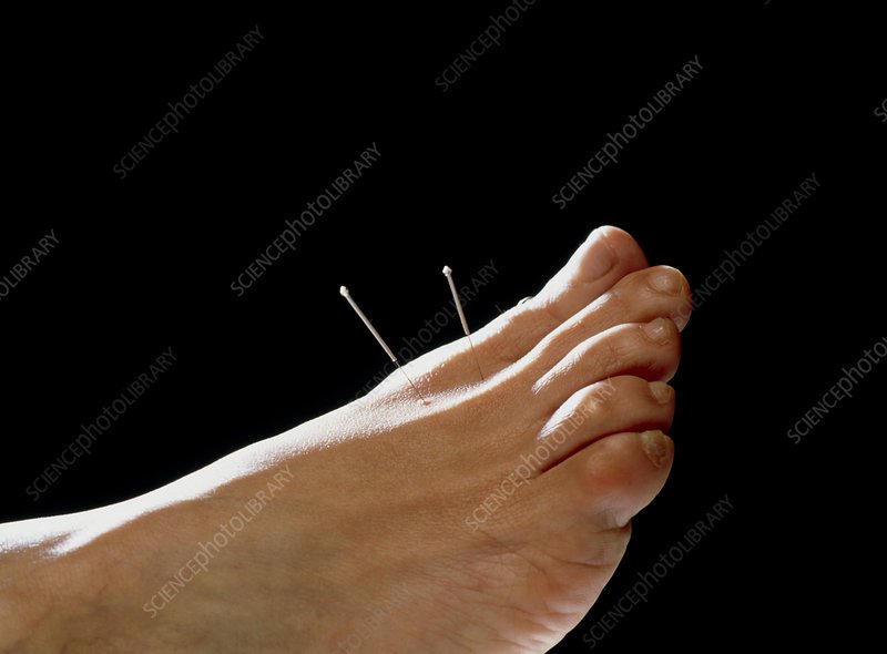 Foot Acupuncture.jpeg