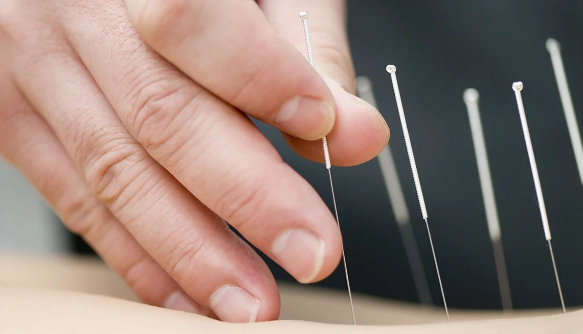 Thin and Gentle Acupuncture Needle Placement