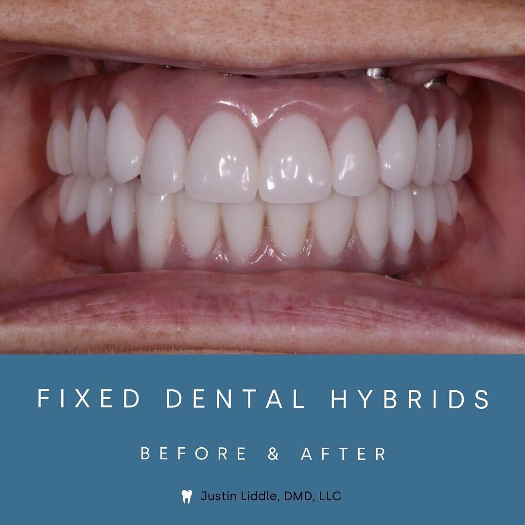 You're going to want to swipe to see the &quot;before&quot; of this complete transformation 🤯

This patient saw her hybrid dental implants and entire mouth fully restored through fill oral rehabilitation 👇

Full oral rehabilitation refers to the pr