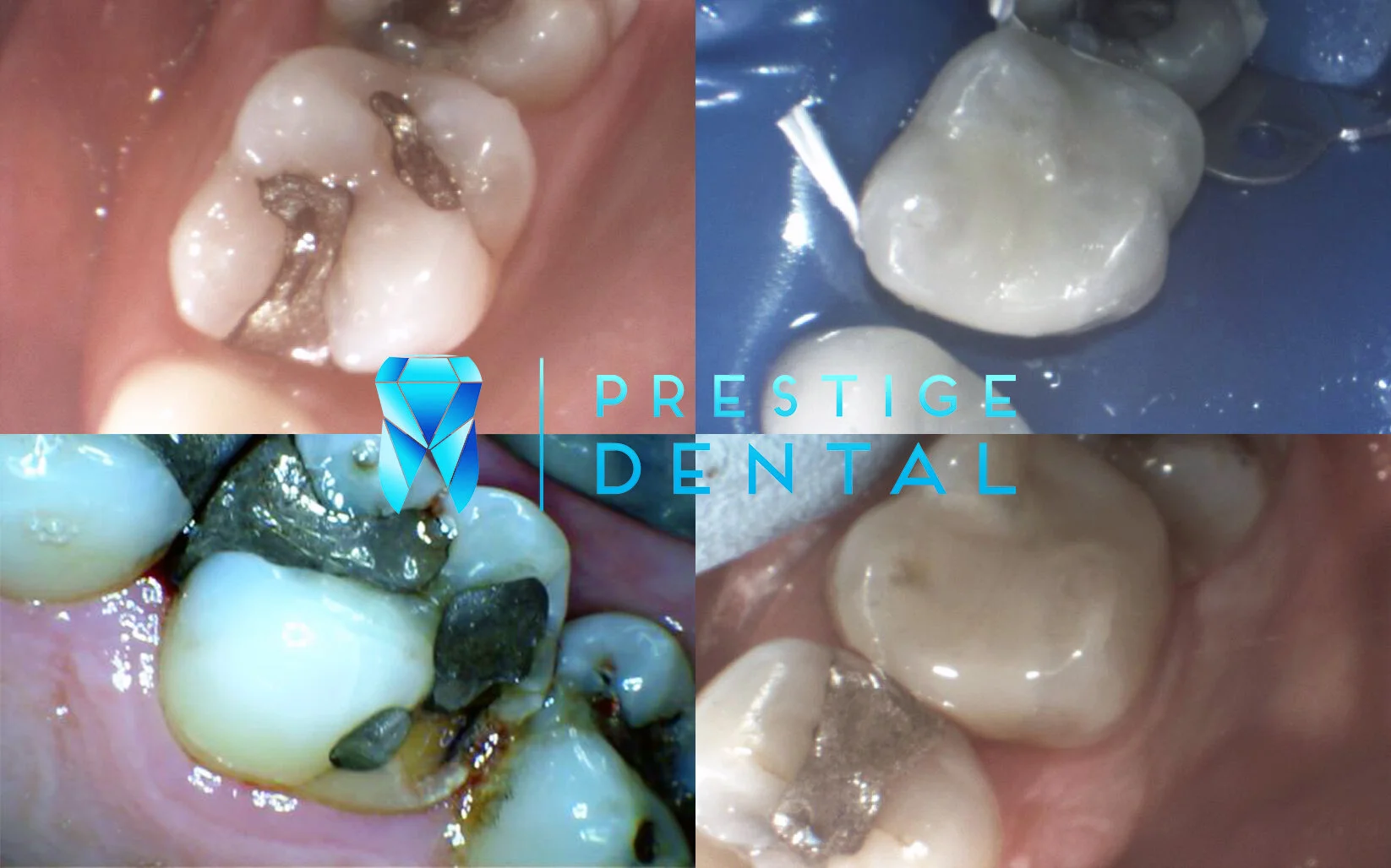 Composite tooth filling in Silverdale Auckland