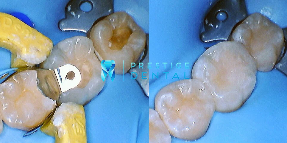 Before and after composite tooth filling in Silverdale Auckland showing natural-looking restoration