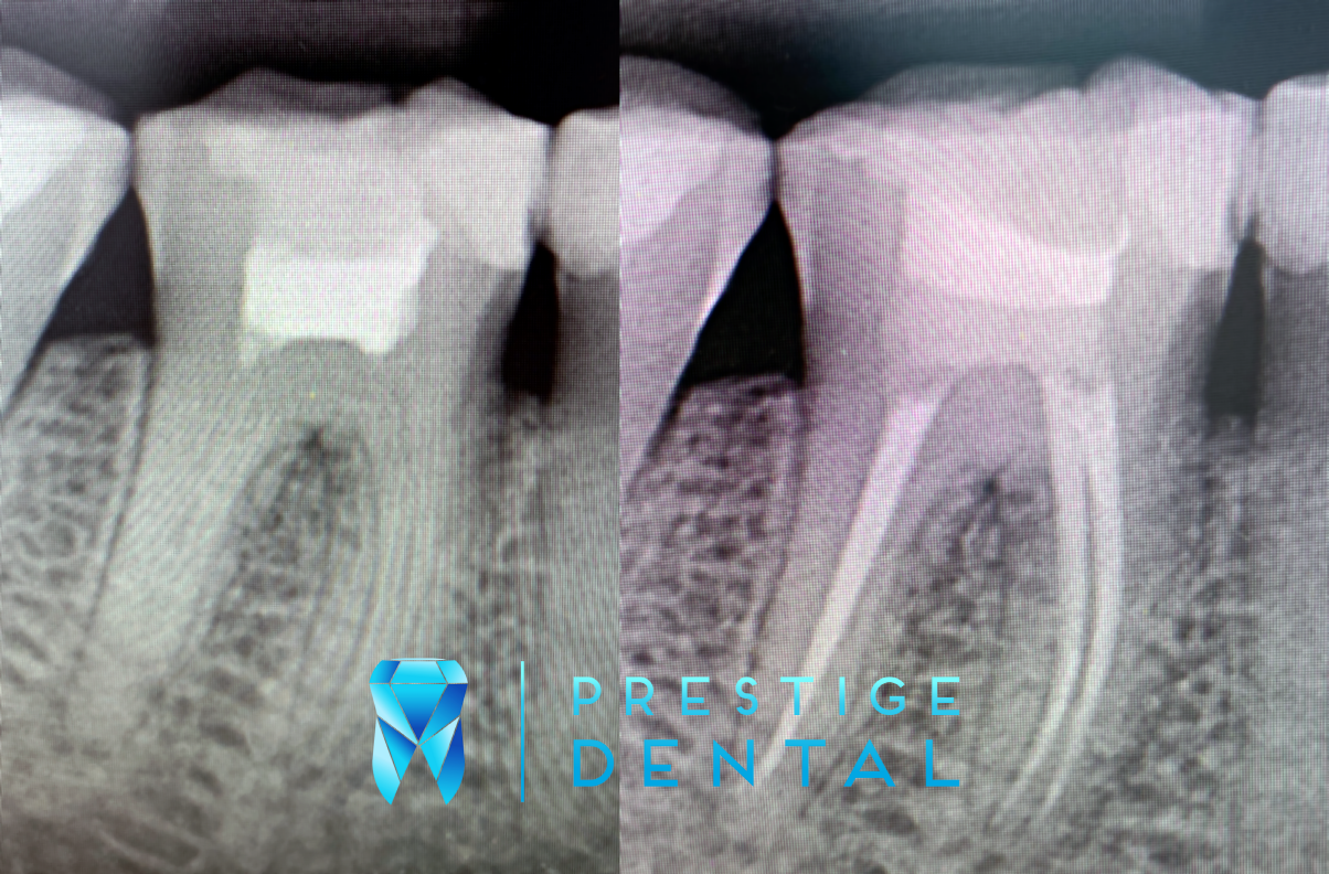 Dental X-ray comparison showing tooth before root canal treatment with infection and after treatment with canals sealed in Silverdale Auckland