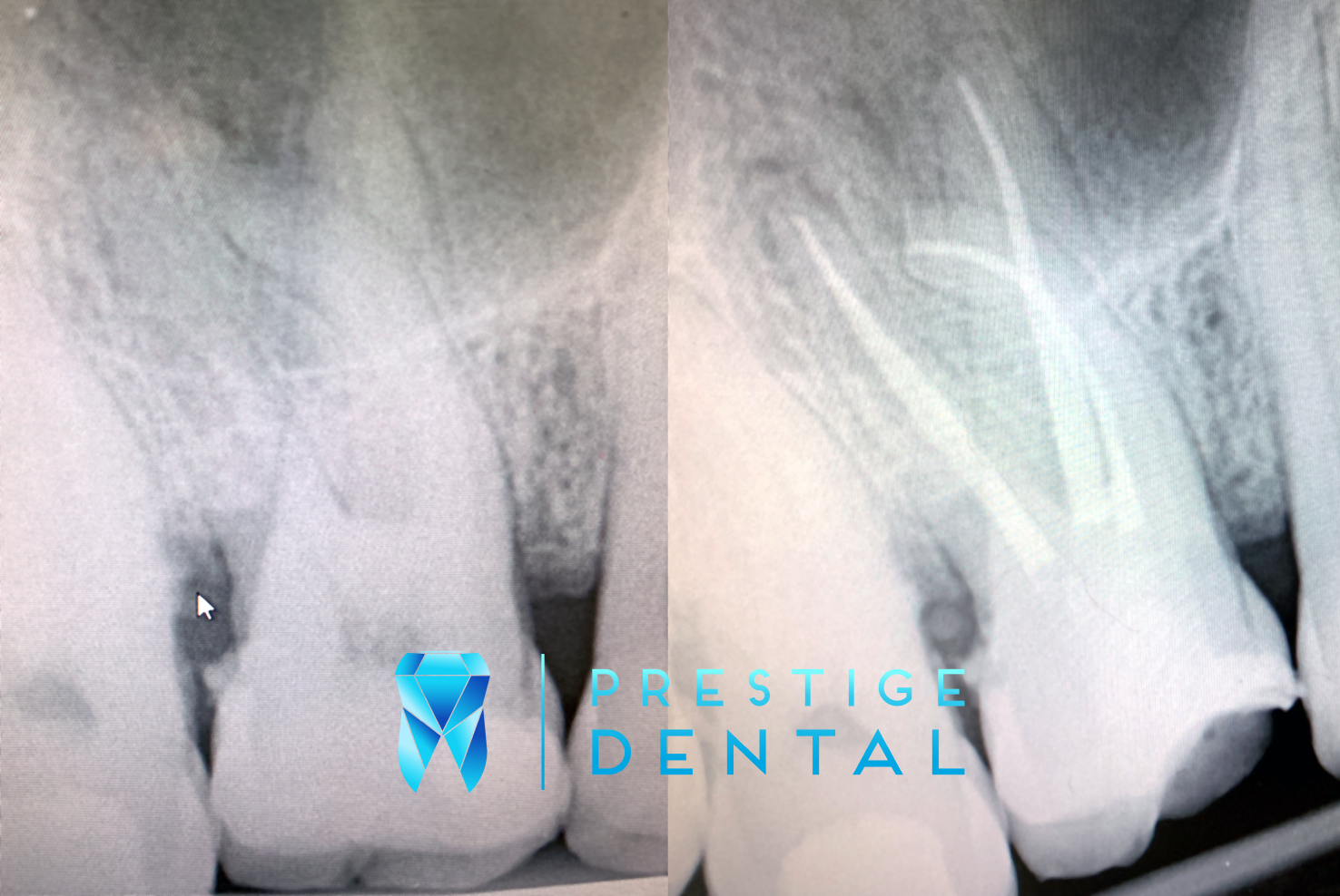 Before and after dental X-ray showing root canal treatment with cleaned and sealed canals in Silverdale Auckland