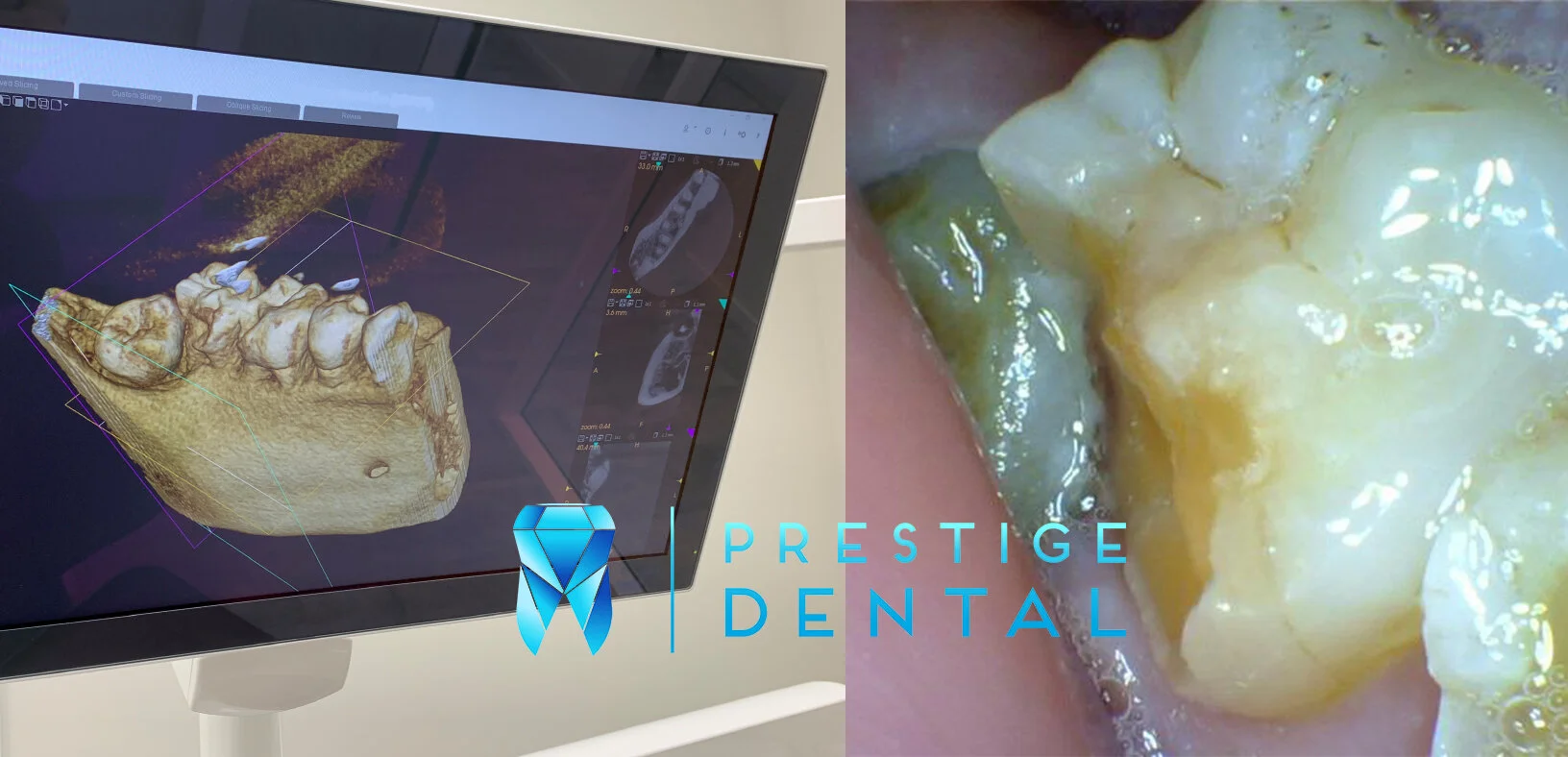 Wisdom tooth extraction treatment performed in Silverdale Auckland dental clinic