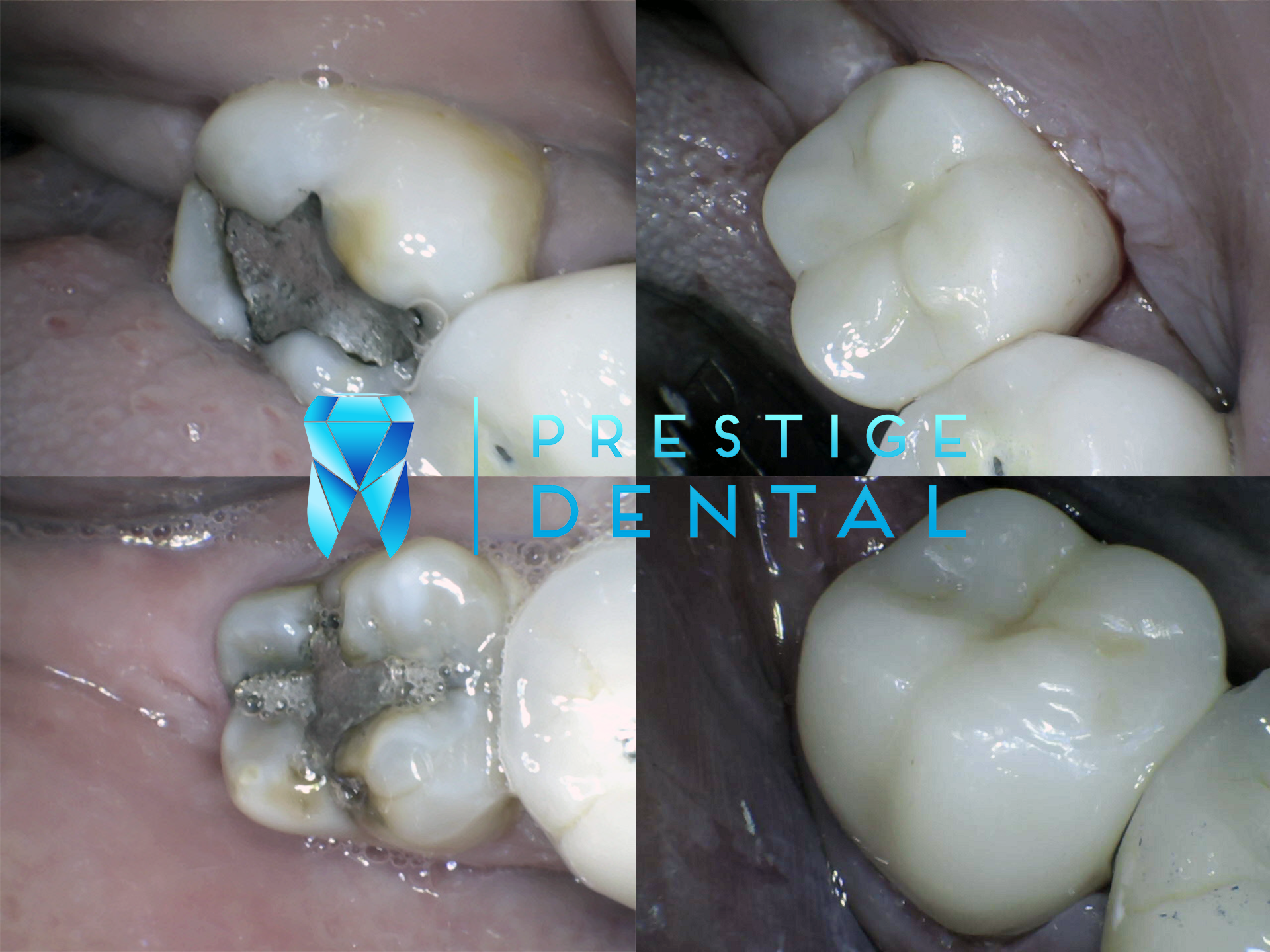 Cracked tooth requiring dental crown treatment in Silverdale Auckland