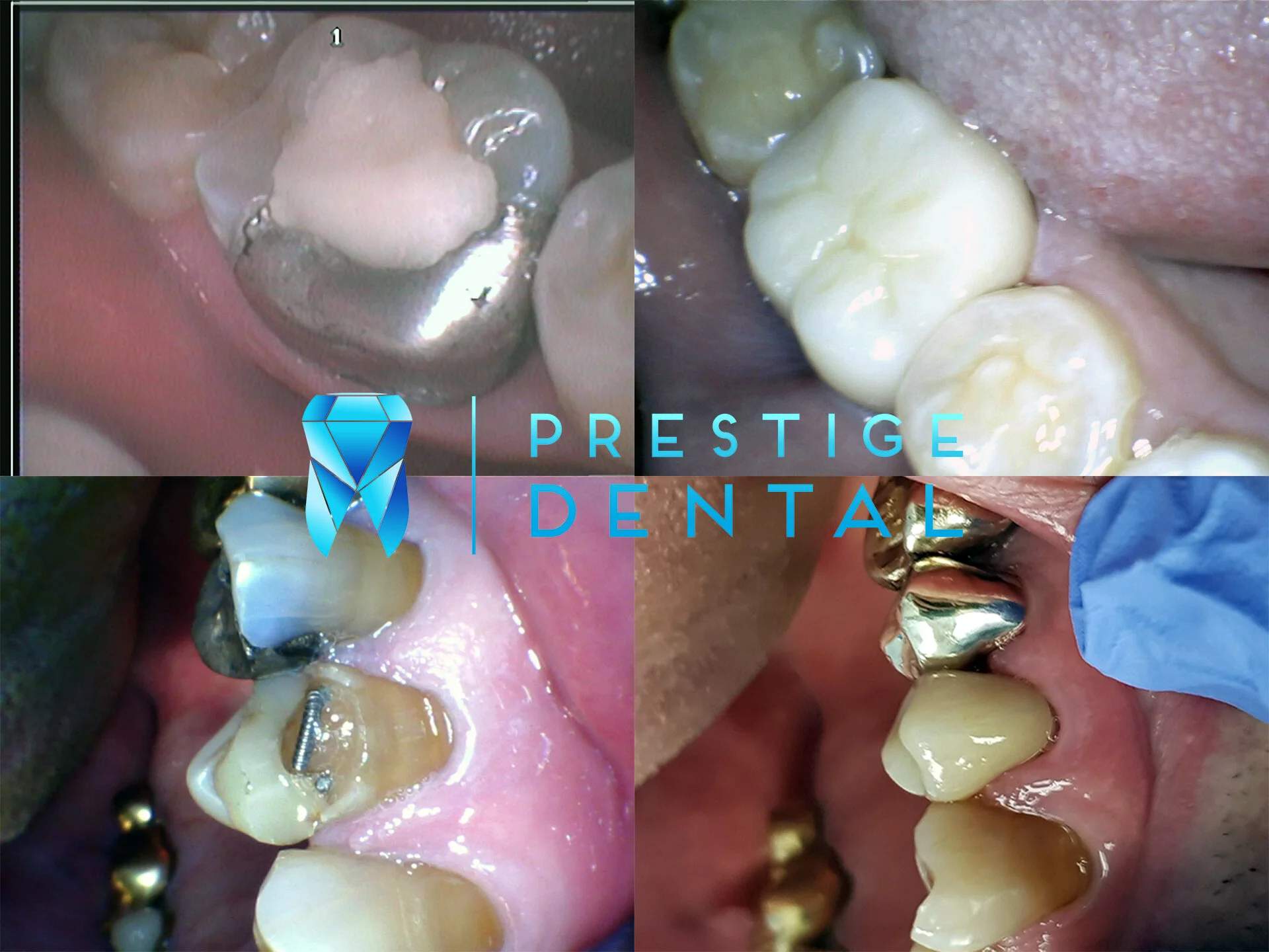 Ceramic dental crown restoring natural tooth appearance and strength