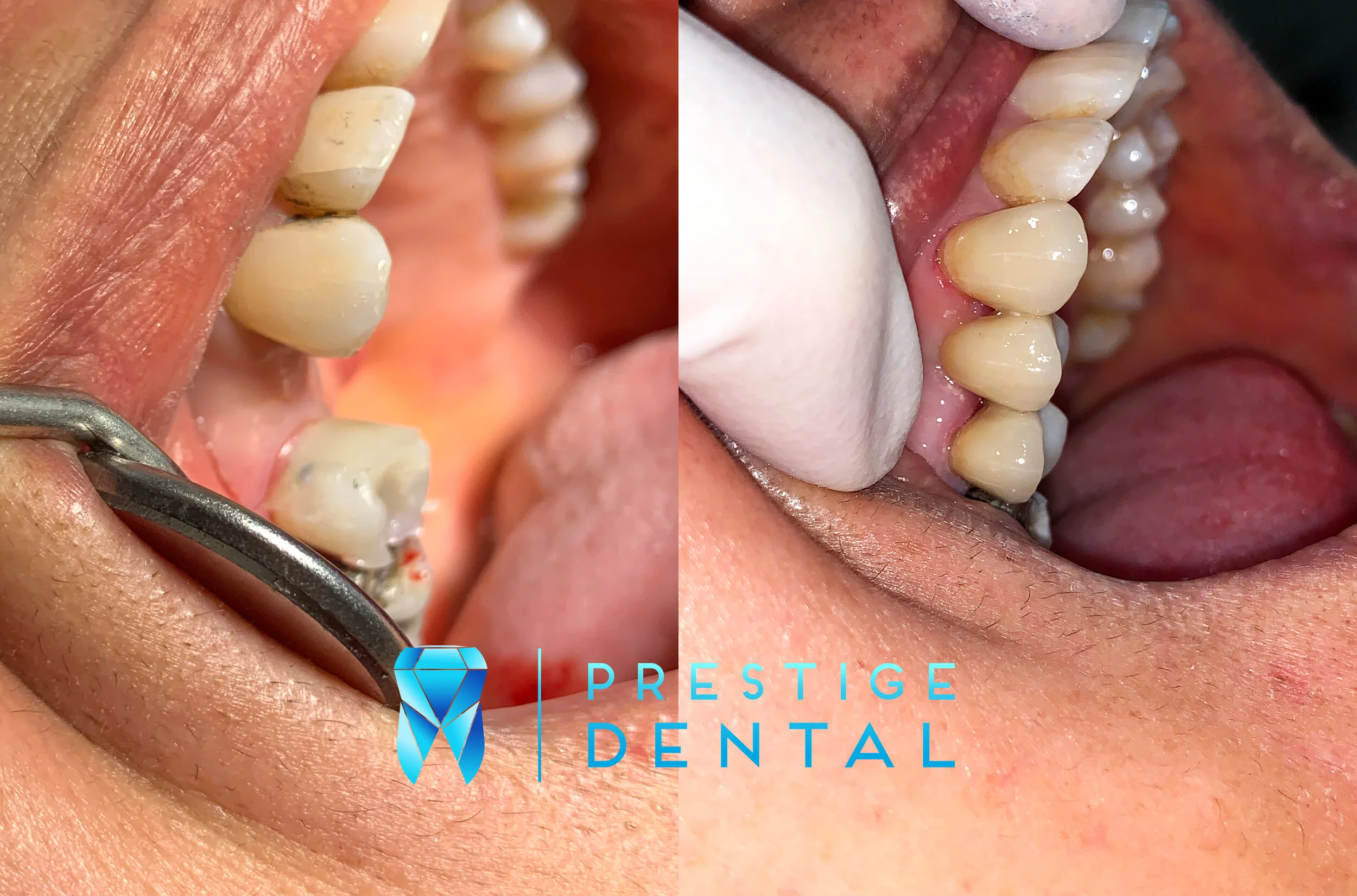 Dental bridge replacing a missing tooth in Silverdale Auckland