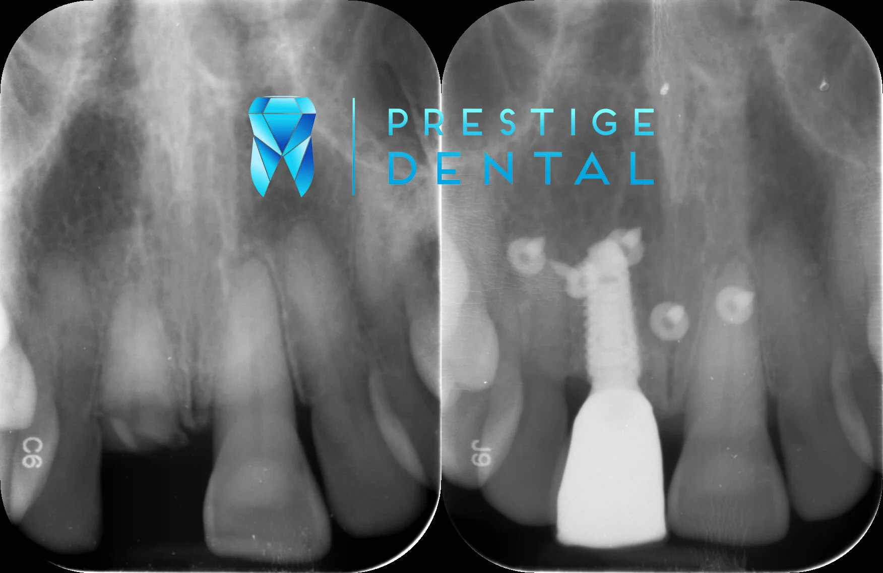 Dental implant replacing a missing tooth in Silverdale Auckland dental clinic