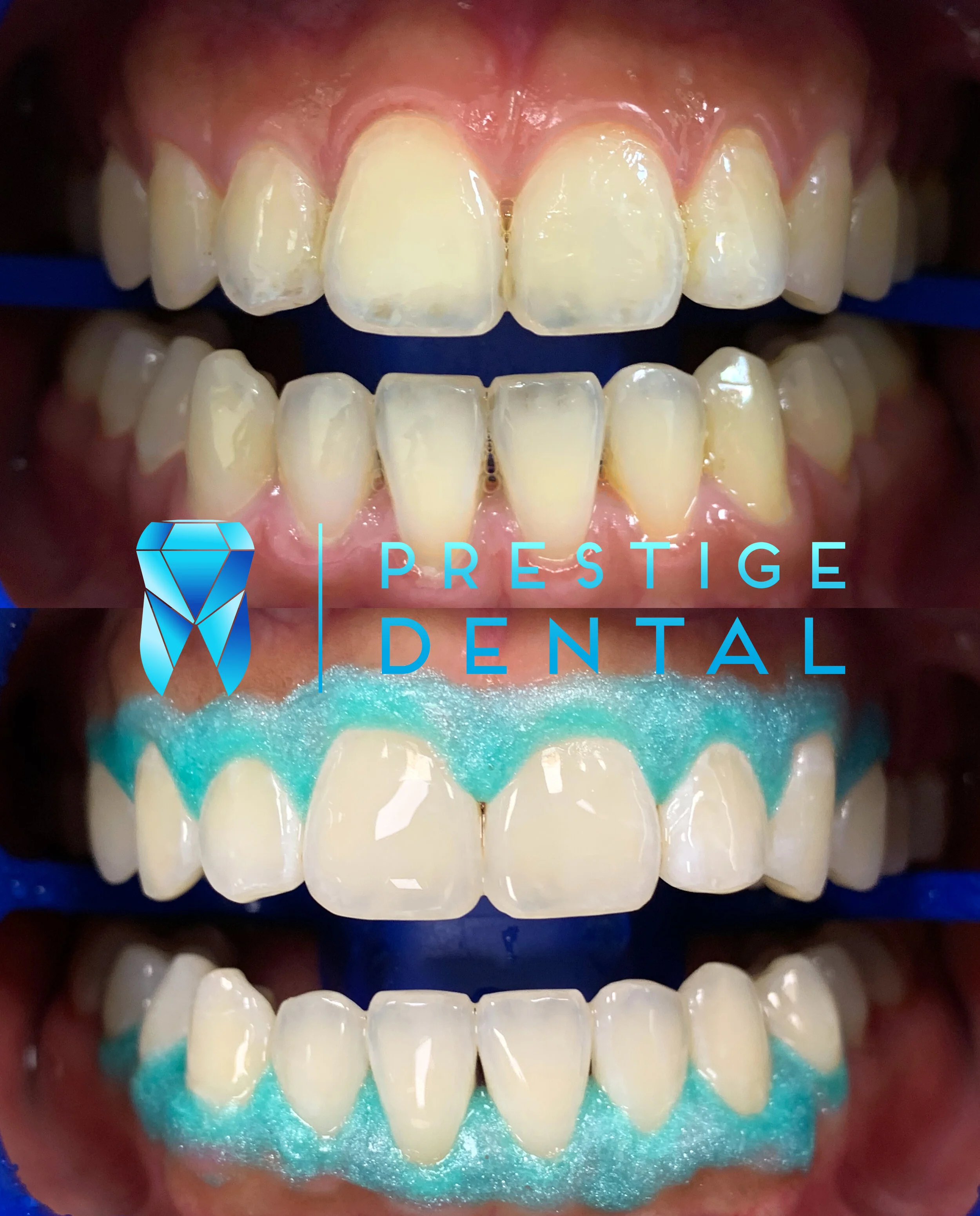 Professional teeth whitening treatment performed in Silverdale Auckland dental clinic