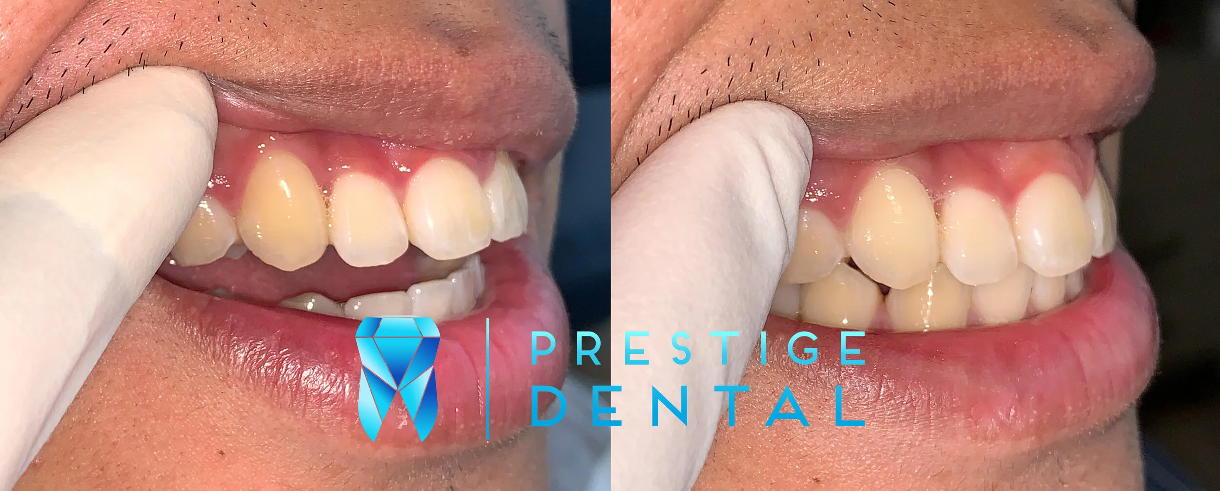 Teeth whitening result showing brighter natural smile in Silverdale Auckland