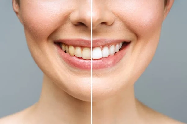 Close-up of a person's smiling mouth showing a before and after comparison of teeth whitening, with the right side displaying white, bright teeth and the left side showing naturally colored teeth.