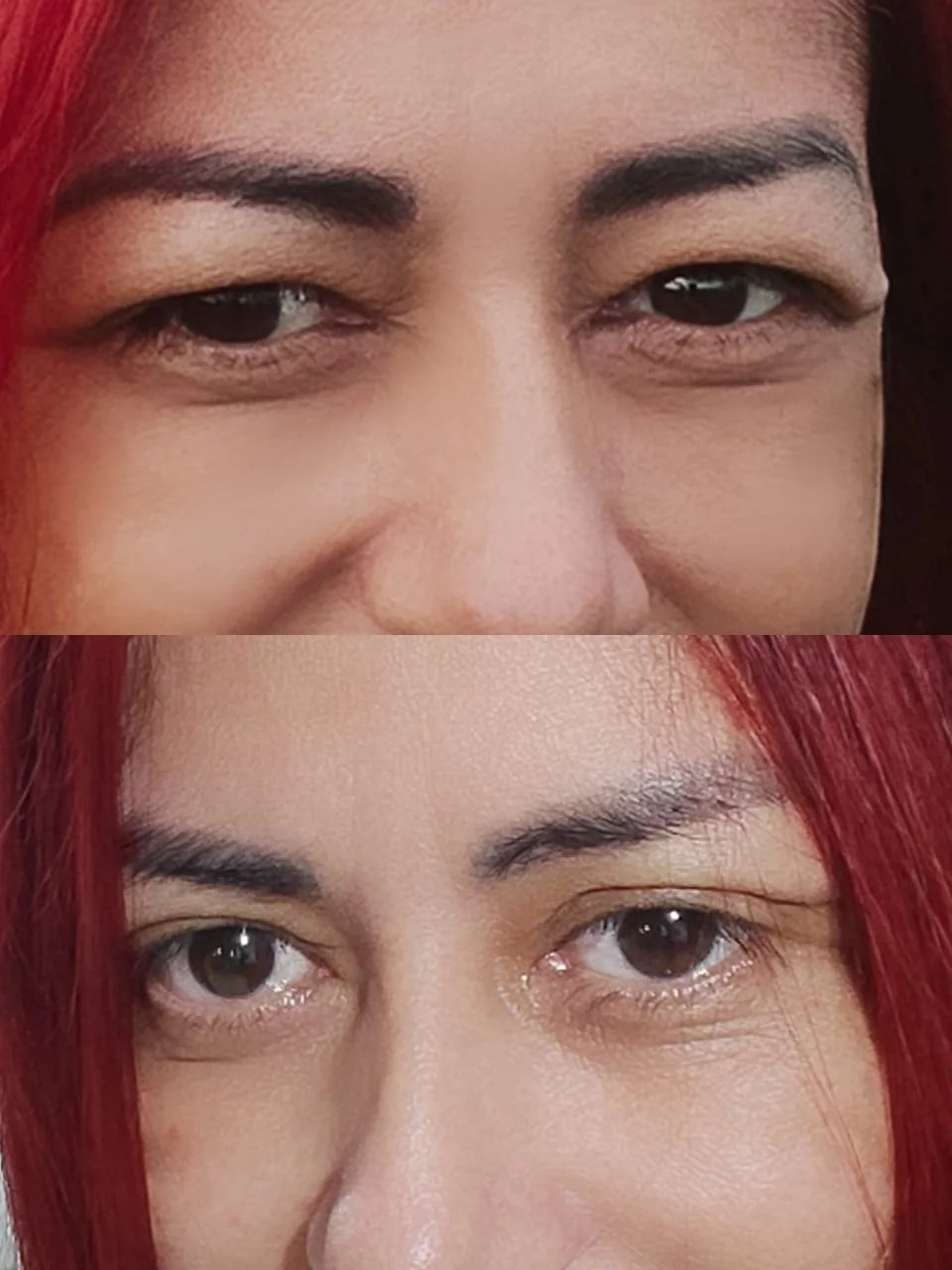 blefaroplastia-02.jpg