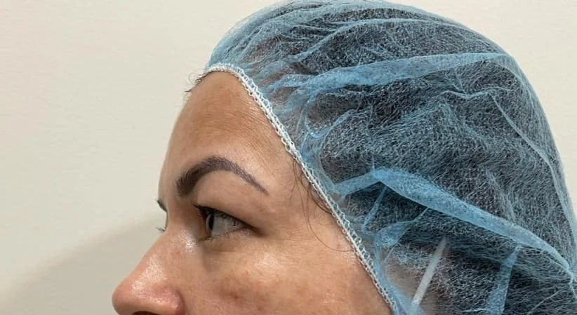 blefaroplastia-12.jpg