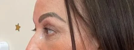 blefaroplastia-03.jpg