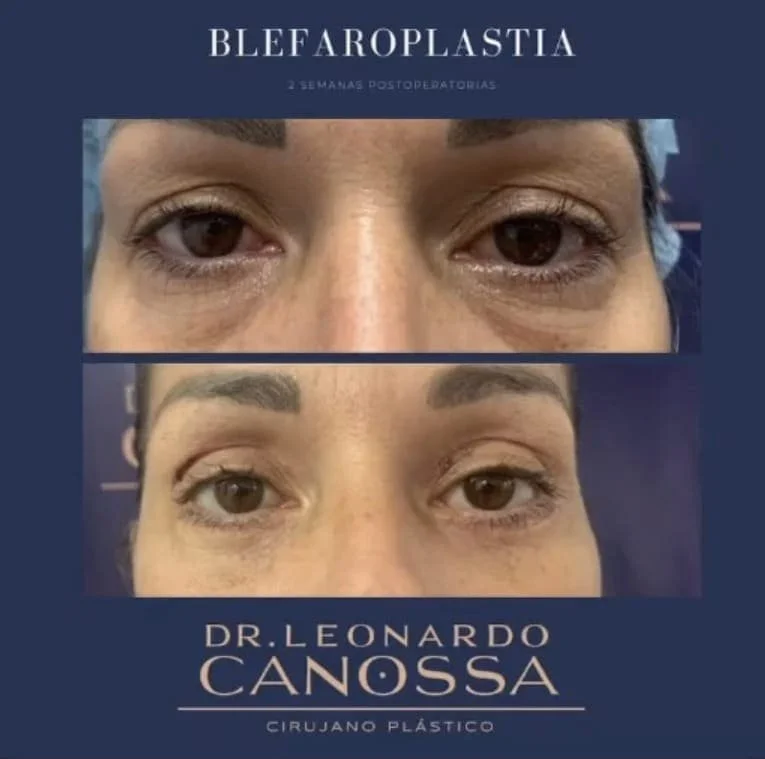 blefaroplastia-01.jpg