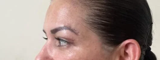blefaroplastia-04.jpg