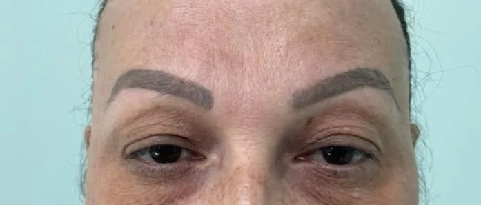 blefaroplastia-10.jpg