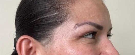 blefaroplastia-05.jpg