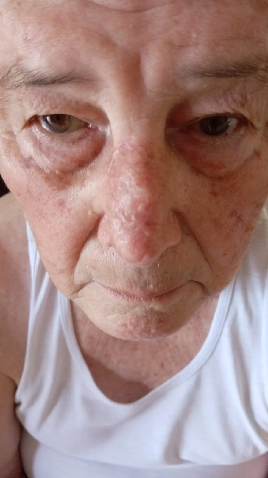 carcinoma-en-nariz-01.jpg