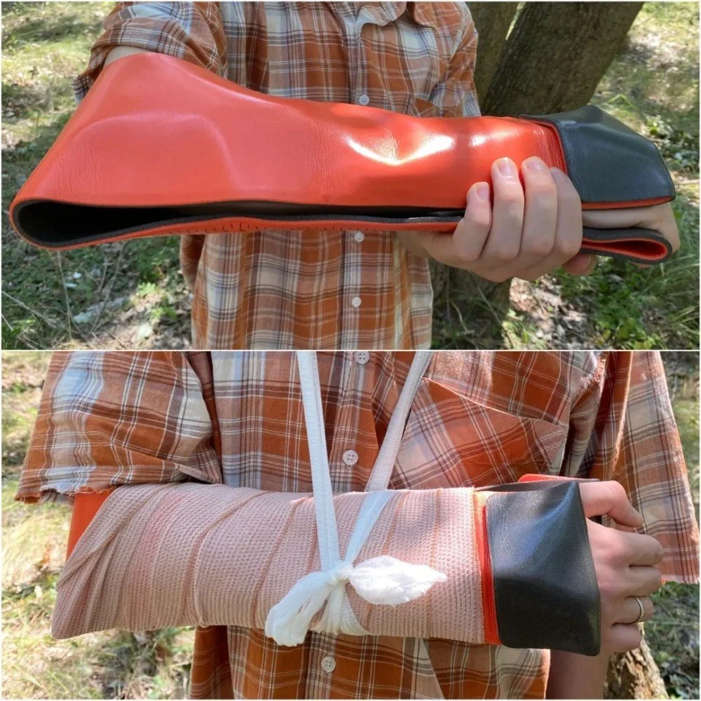 Splinting upper limb fractures — Munro Medical Solutions Medical