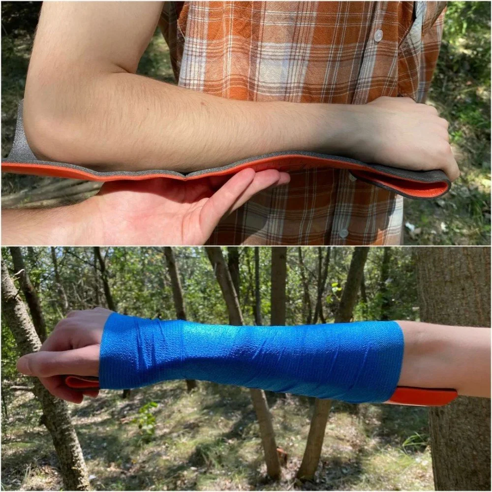 Splinting upper limb fractures — Munro Medical Solutions Medical