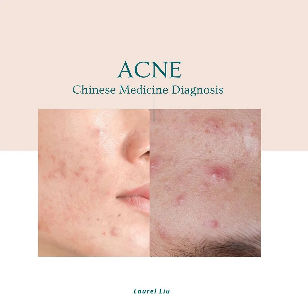 As I said earlier, we are going to discuss two topics per month.
The first topic we are going to talk about is the traditional Chinese medicine diagnosis and treatment for acne.
The root cause for acne is the HEAT in our body, however, what is the