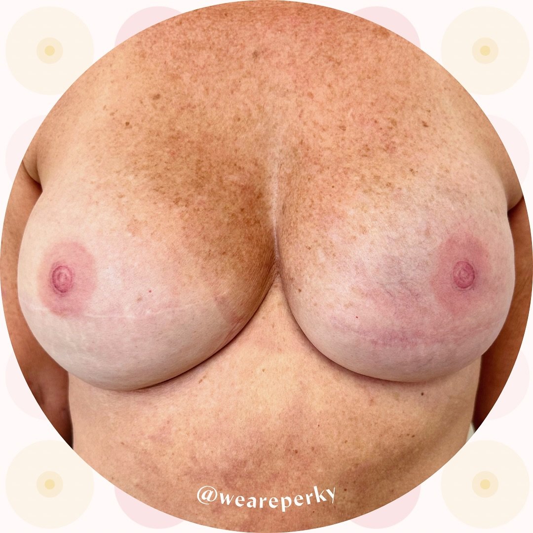 We&rsquo;re interrupting your Black Friday shopping to bring you these beautiful fully-healed reconstructive tattoos for one of our breast cancer survivors 🙌

This beautiful client wanted to recreate what she had prior to her bilateral mastectomy an