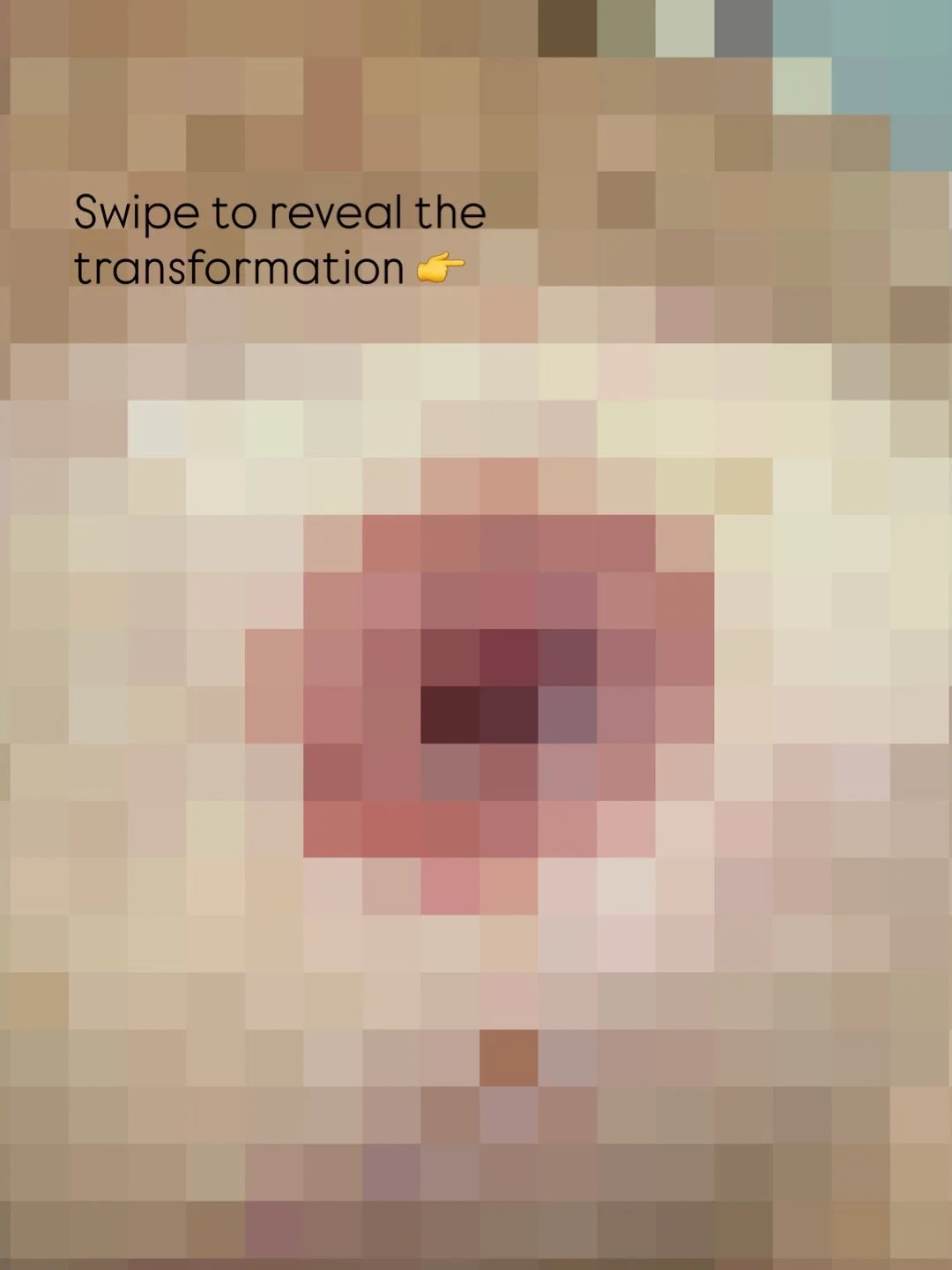 Sometimes healing gets censored. So we have to get a little creative. 😉

Swipe through to reveal this fresh restorative nipple tattoo on a surgically reconstructed nipple bud, created on post mastectomy scarring as part of someone&rsquo;s breast rec