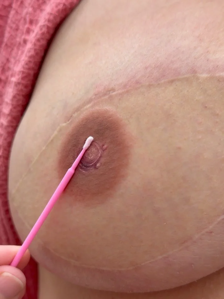 Touch up days are the best days 🙌

A touch-up can enhance color, definition, symmetry, and those tiny details that make a 3D nipple tattoo feel even more like you.

THIS IS A POST MASTECTOMY TATTOO ON A BREAST CANCER SURVIVOR SHOWN FOR ARTISTIC AND 