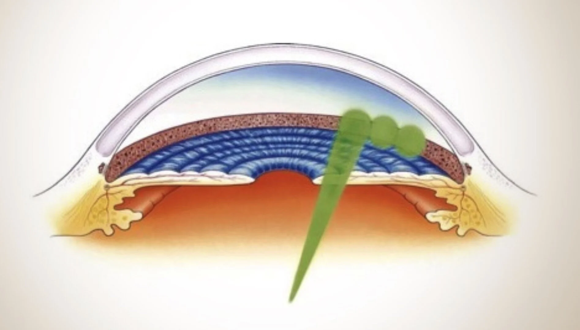 SLT Gentle Laser Treatment — Wollongong Eye Doctor