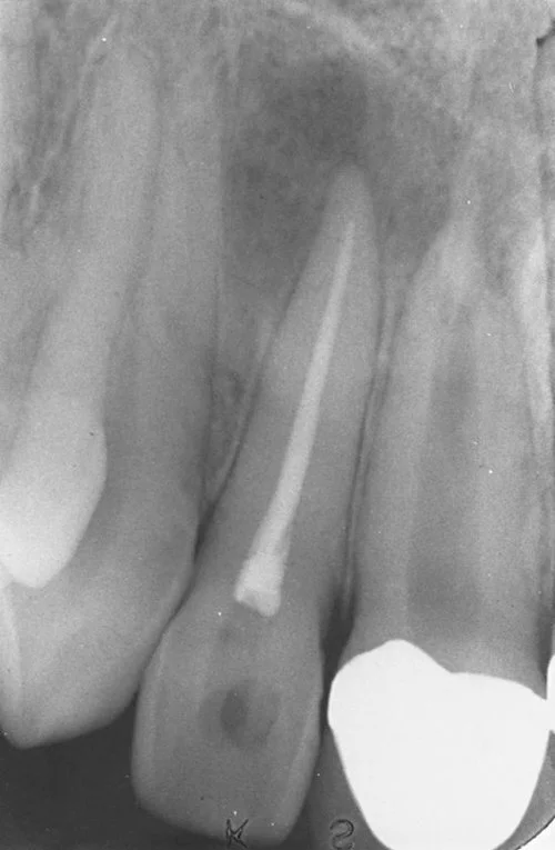 root+canal.jpg