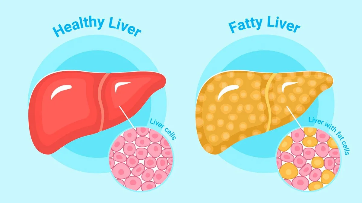 Join Fatty Liver ECHO