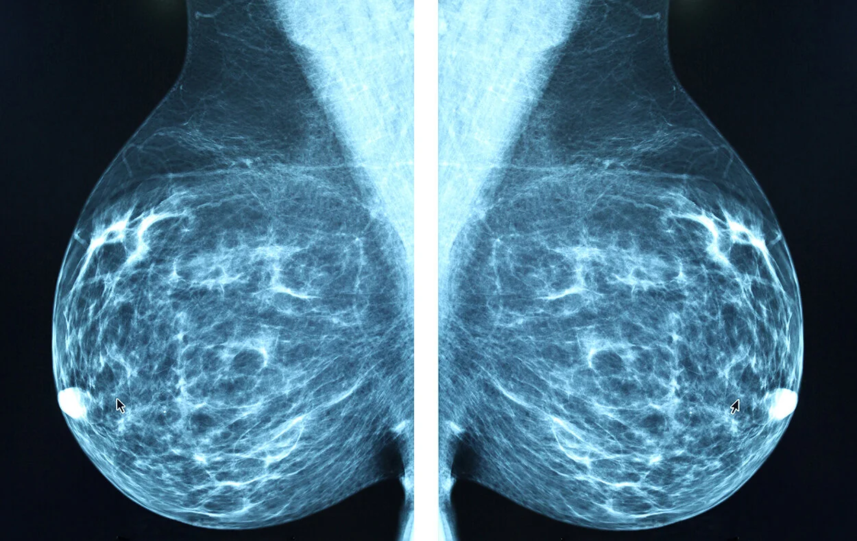Breast Cancer Xray of breast tissue