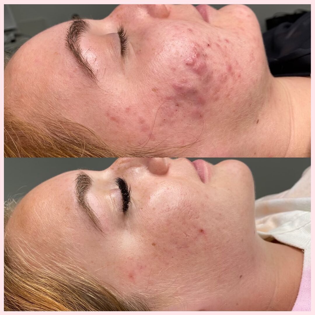 ✨PROGRESS✨  Before and After 7 months of progress and commitment! 

We started with a series of Hydrafacial + Green Peels to help target the following:

☑️Skin Tone, Texture &amp; Brightness
☑️Acne &amp; Blemishes
☑️Dry or Dehydrated Skin
☑️Hyperpigm