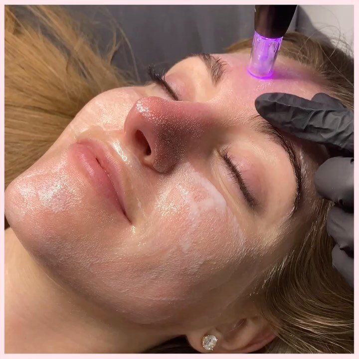 💉NANO INFUSION 💉 

What is Nano Infusion? (Custom Infusion  or CBD Infusion available)

Nano Infusion is a treatment used to feed your skin of vitamins and hydrators making it look brighter, tighter and GLOWING! It works on the outermost layer of t